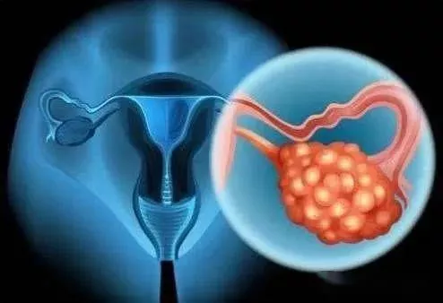 【研究】Cell突破：新生物标志物——卵巢癌患者的新希望！