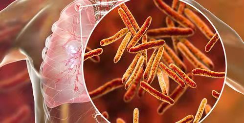 【突破】可怕！科学家发现结核病细菌竟然可以通过呼吸传播！