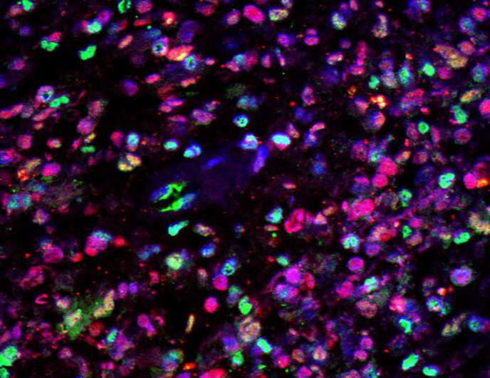 【Nature子刊】突破！干细胞技术和下一代DNA测序发现最常见、难治的脑肿瘤——多形性胶质母细胞瘤的新治疗靶点