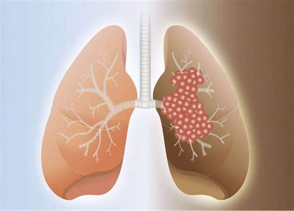【Nature子刊】新方法！鉴定侵袭性早期肺癌，为治疗带来巨大进步！