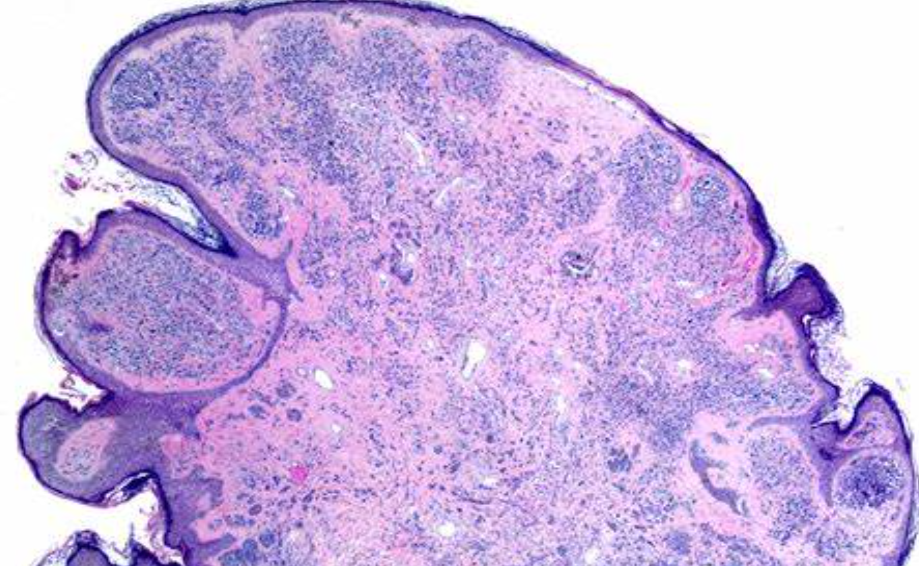 【Nature Communications】小心痣！它可能会转化为致命癌症！