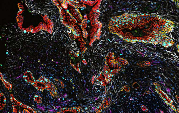 【Nature子刊】人类肿瘤图谱网络——胰腺癌发展的新见解
