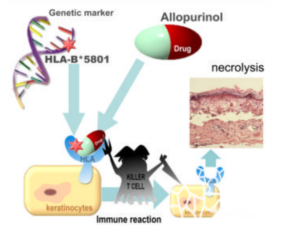 痛风 | HLA-B*5801基因检测指导别嘌醇安全用药