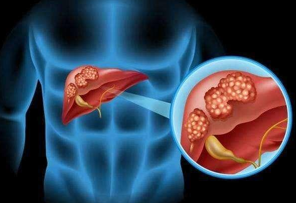 【Journal of Hematology & Oncology】曹雪涛团队研究提出预防肝癌的机制见解和潜在靶点