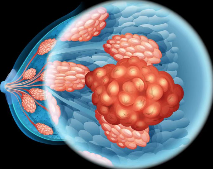 【Nature】重磅！空间基因组学：助力科学家绘制癌症进化谱系图，破解乳腺癌扩散机制