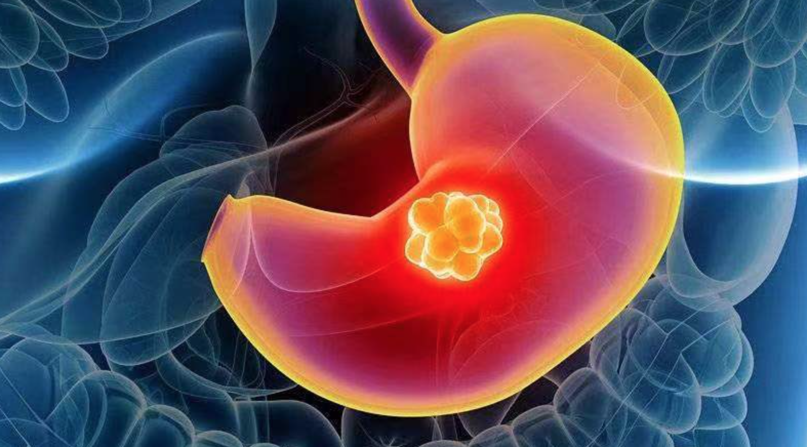 【Nature子刊】南医大团队发表胃癌研究最新成果，揭示病理学特征在胃癌中的预后和预测价值
