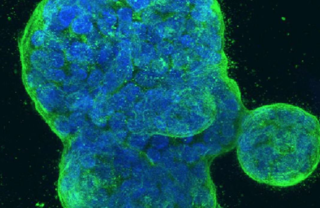 【JAMA ONCOL.】最新！华盛顿大学研究人员发现可安全抗肿瘤的乳腺癌疫苗