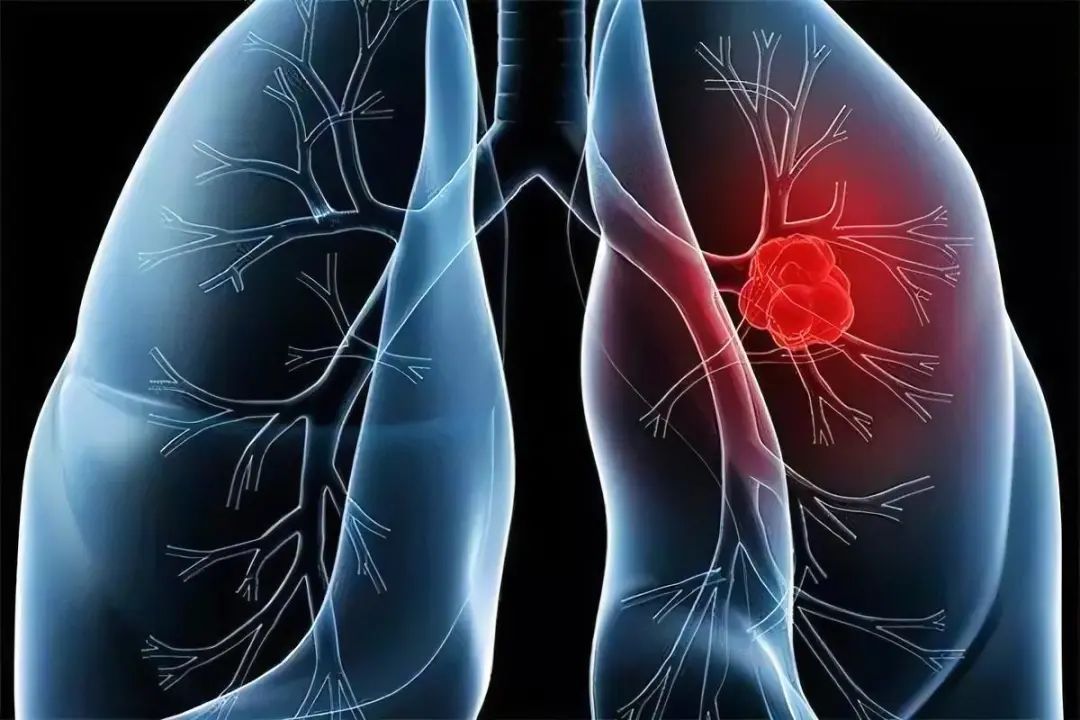 【JCI】清华大学胡泽平团队发现调节EGFR突变肺癌治疗耐药的新策略！