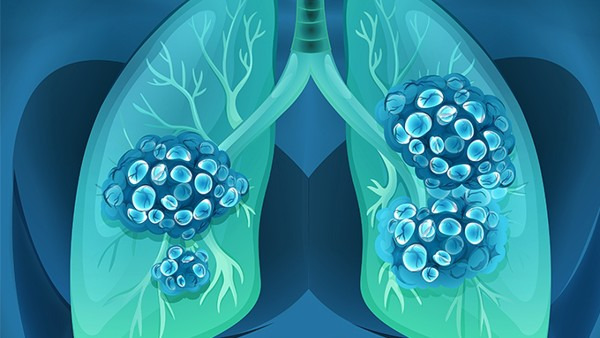 【Immunity】为何免疫系统对肺癌的反应迟钝？麻省理工团队发现肺部中天然存在的细菌竟抑制T细胞激活