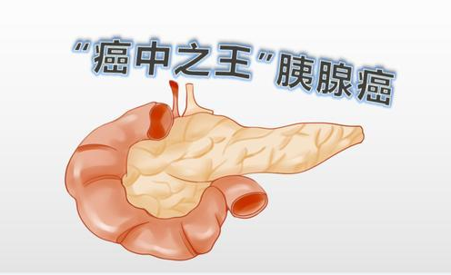 【Science 子刊】新发现生物标记物！有望识别“癌中之王”的早期风险