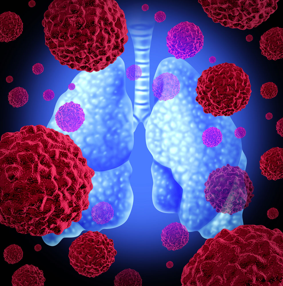 【Lancet子刊】重磅！上海交大/浙江大学发现非小细胞肺癌潜在治疗新方法