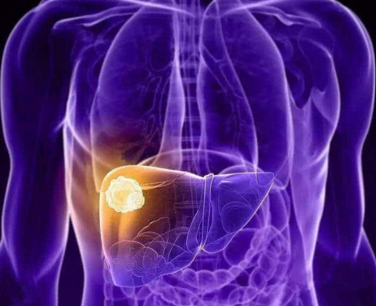 攻克“聪明肿瘤”耐药性！广州大学研究发现靶向肝癌新策略