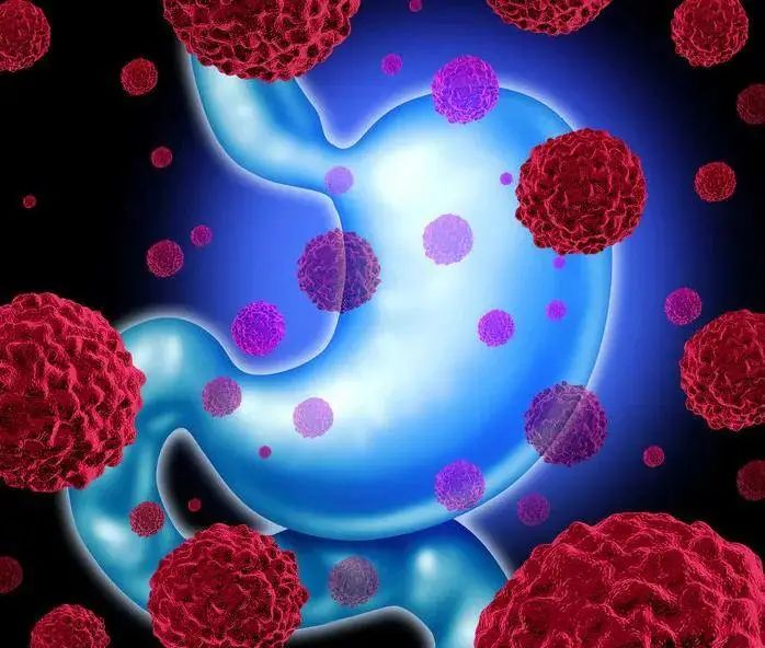 南方医科大学发现胃癌细胞缺氧耐受新机制 揭示胃癌治疗新策略
