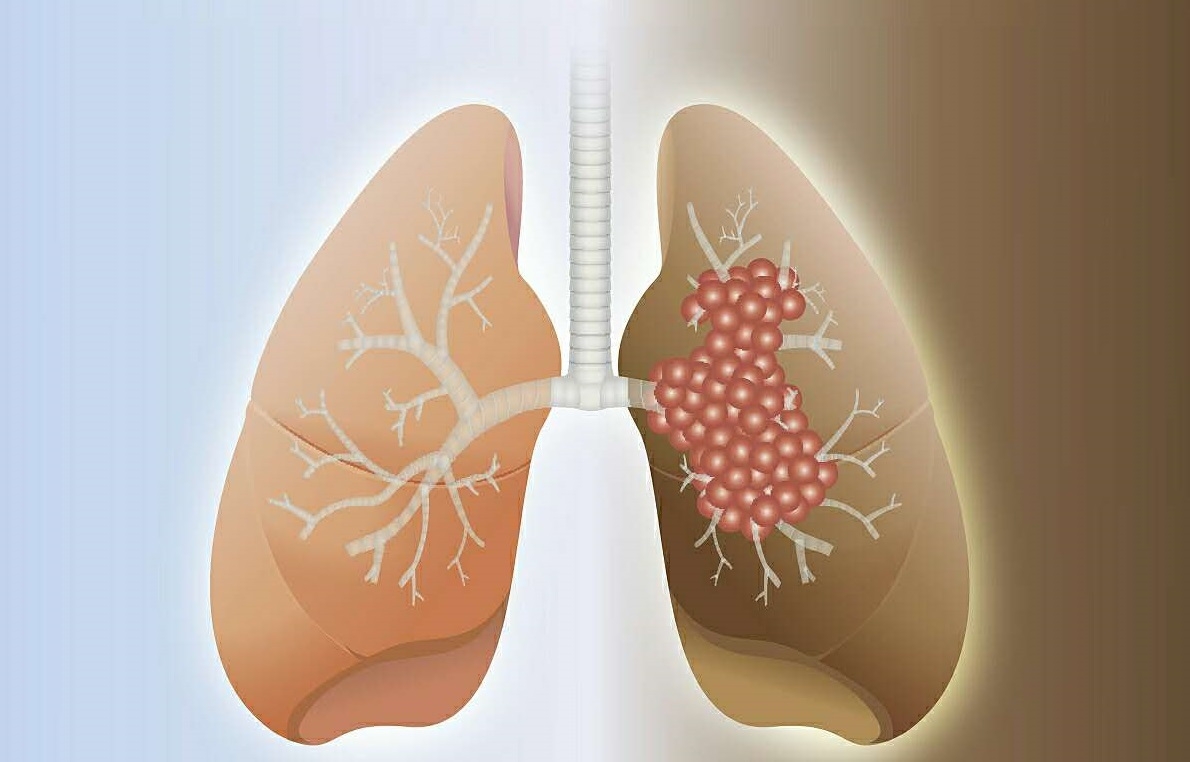 重磅！中南大学湘雅医院揭示肺腺癌诊断潜在生物标志物和治疗新靶点