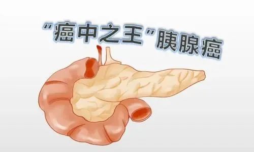 重大突破！哈佛医学院发现早期胰腺癌筛查新策略和生物标志物