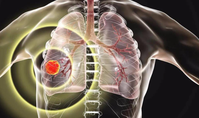 南京医科大学|中国医学科学院研究揭示肺腺癌淋巴结转移的驱动因素和治疗靶点
