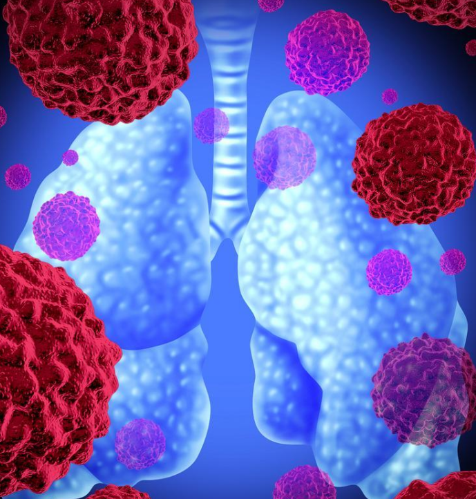 重磅揭秘！北京大学发现非小细胞肺癌发病新机制