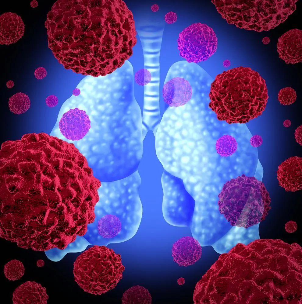 重大进展！中国医科大学发现非小细胞肺癌化疗耐药的新机制 揭示化疗的潜在治疗靶点