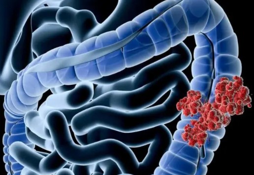 【Autophagy】中山大学研究发现贝伐珠单抗治疗直肠癌产生耐药性的潜在机理