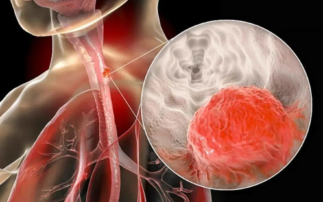 【Adv. Sci.】同济大学首次确认食管鳞癌进展和耐药性的新机制并揭示新的治疗策略