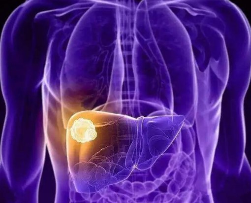 让52%“不可手术”的肝癌患者“可手术”！中国学者最新研究发布