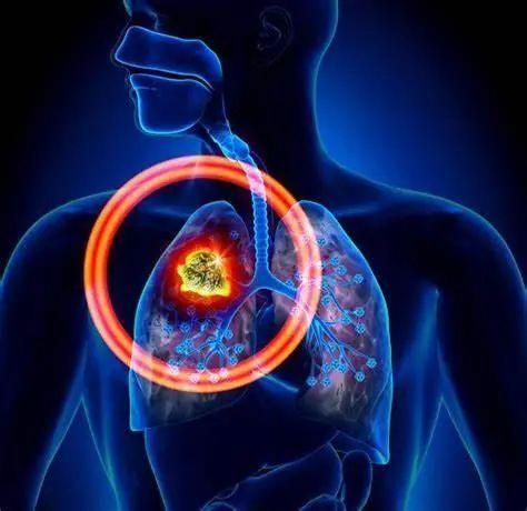 国家癌症中心学者领衔：单细胞RNA测序分析为肺癌的早期诊断和治疗提供新的见解