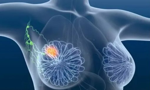 再添进展！复旦大学邵志敏、江一舟等再发文：构建乳腺癌单细胞图谱 揭示乳腺癌生态系统多样性