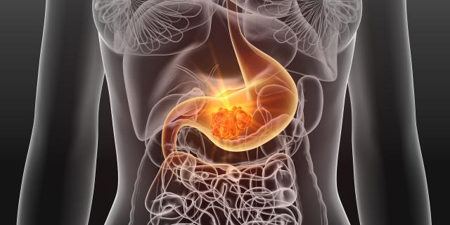 协同抗癌，减弱毒性副作用！川大华西学者发布抗击胃癌新策略