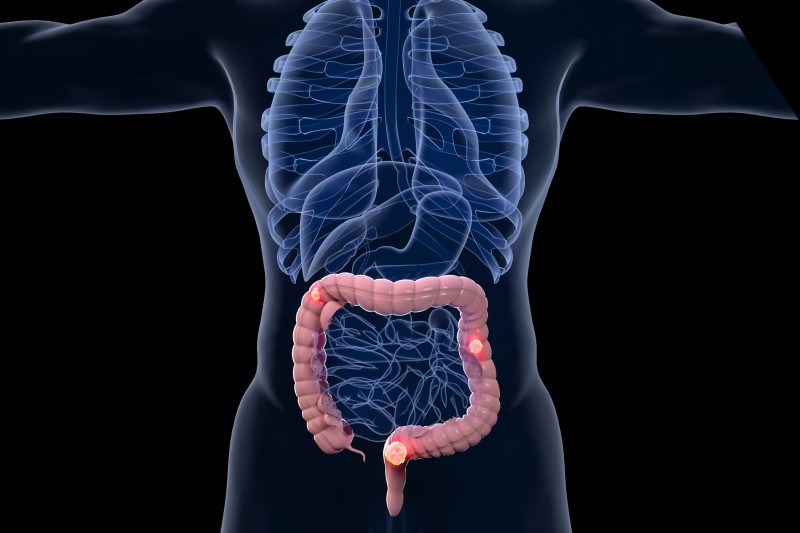 新治疗选择！浙大医学院揭示结直肠癌致癌机制和最新药物