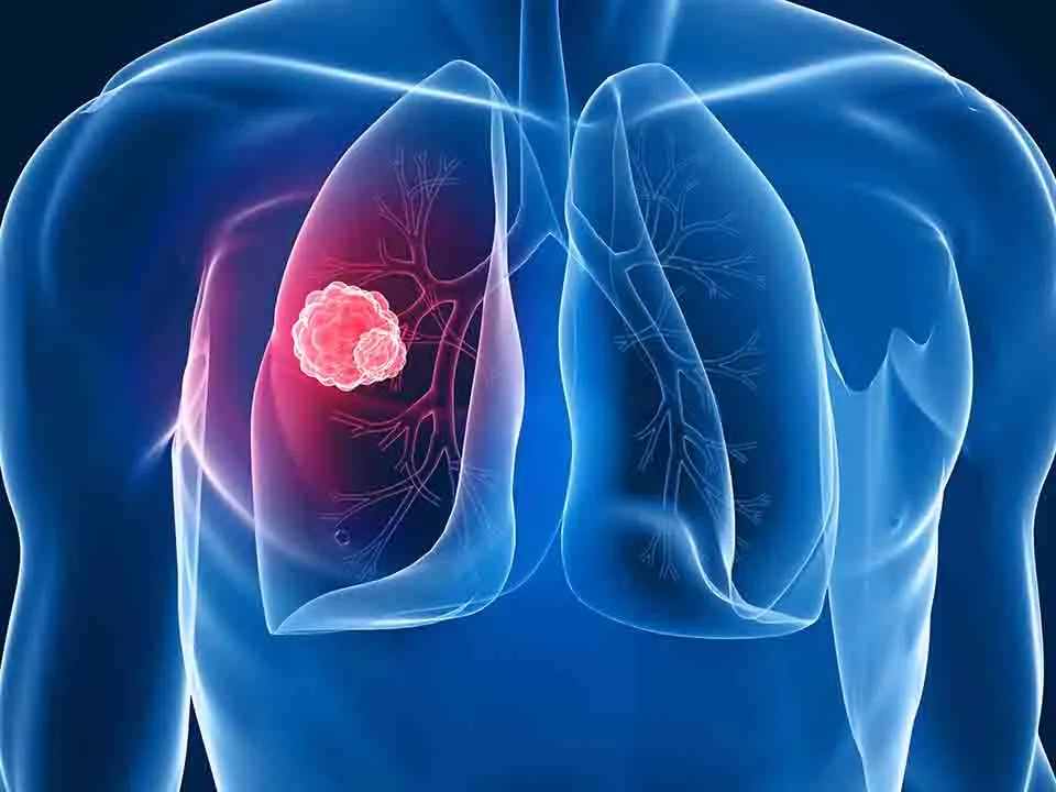 新型生物标志物！中南湘雅研究团队发文：揭示非小细胞肺癌免疫治疗策略