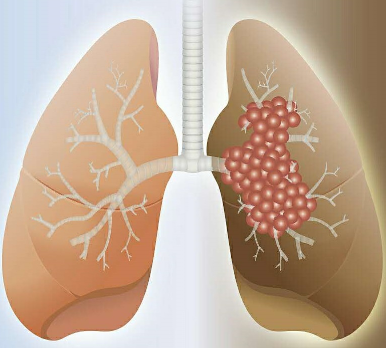 “肺癌治疗”迎“突破”！中国医学科学院北京协和医学院：发现抗PD-L1加化疗联合治疗的有效生物标记物