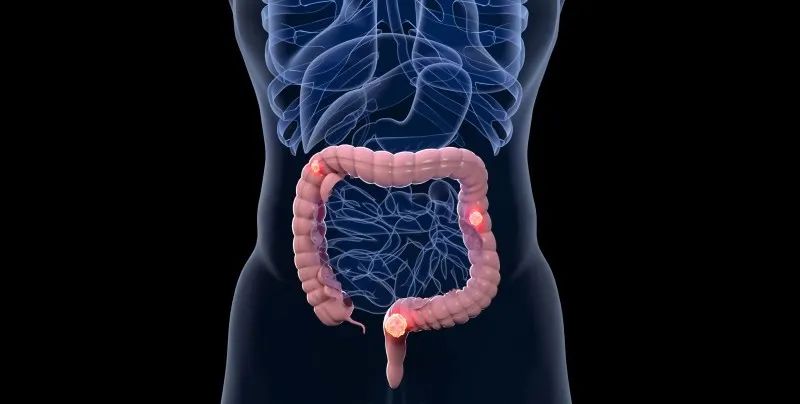 最新抗癌药物！中山大学：结直肠癌潜在生物标志物和治疗靶点