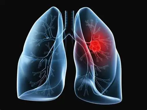 最新！中国科学技术大学潘跃银/张志红团队揭示非小细胞肺癌转移潜在机制
