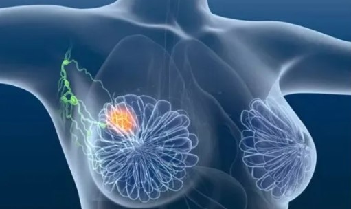 再取进展！复旦大学李大强/邵志敏等合作揭示三阴性乳腺癌的潜在治疗新靶点