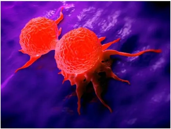 中山大学最新研究：发现“最毒乳腺癌”治疗新靶点，开启治疗新篇章