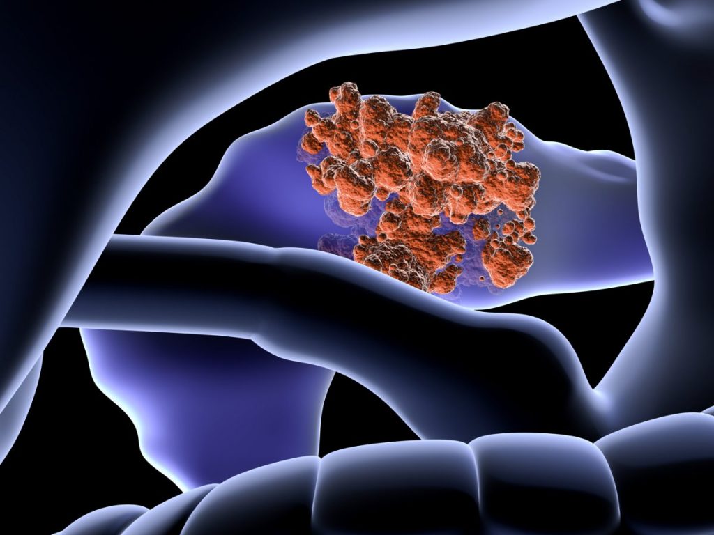 壶腹腺癌的基因图谱：复旦大学的综合蛋白质基因组学研究