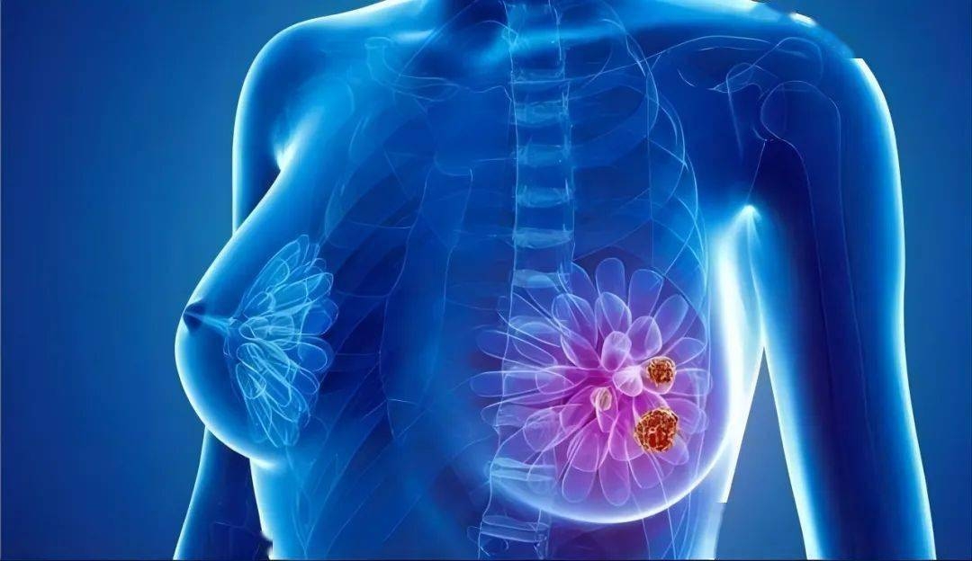 强效抑肿瘤！中国科学技术大学发文：乳腺癌中潜在的治疗靶点和预测生物标志物