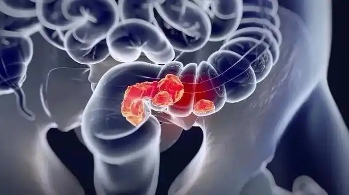 抑制肿瘤生长并提高生存率！南京医科大学附属苏州医院发文：新型结直肠癌免疫治疗策略