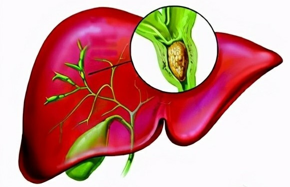 胆管癌发病机制新探索！南京鼓楼医院/锡山人民医院合作发文：极具前景的诊断标志物、预后指标和治疗靶点