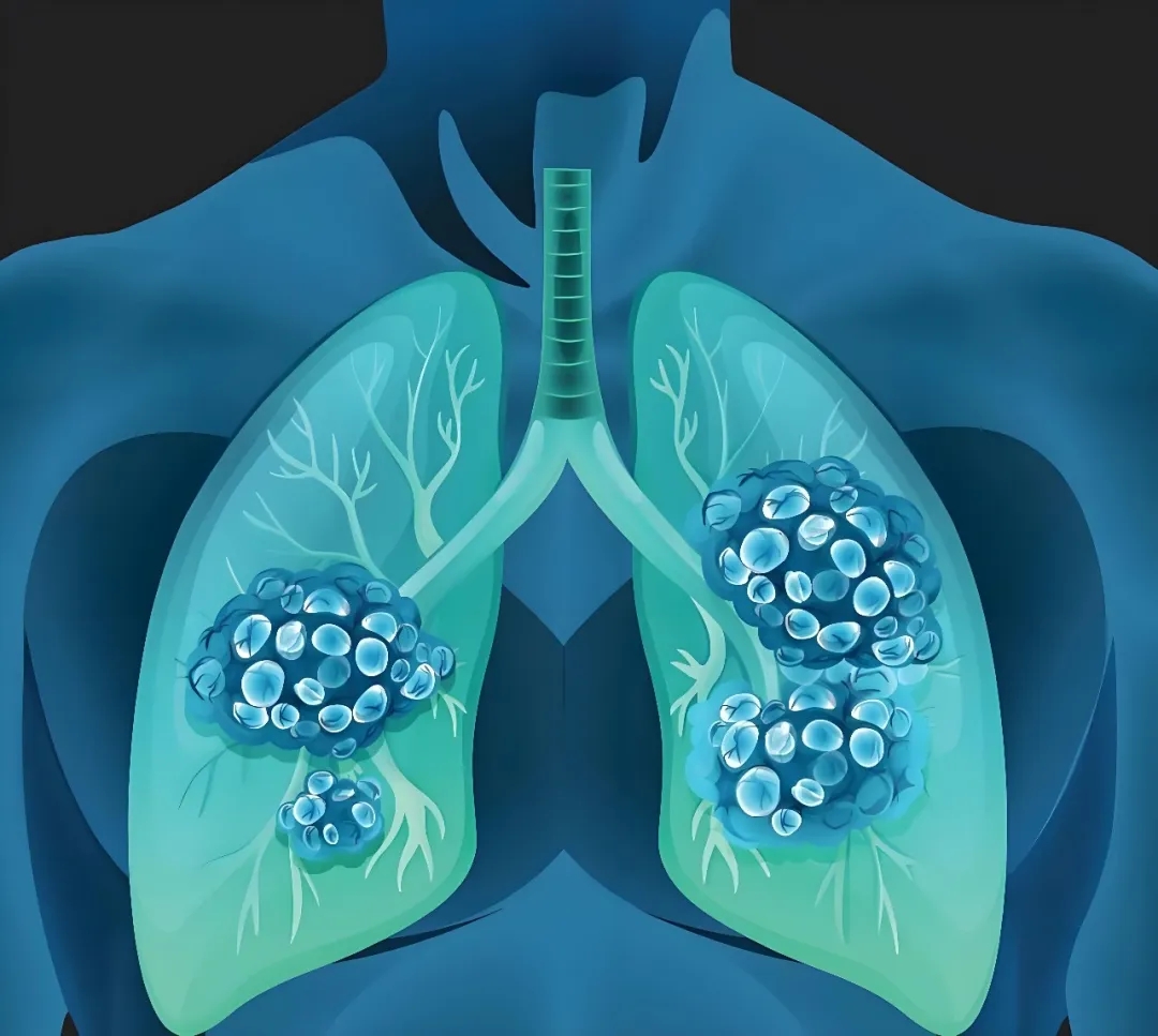 克服化疗耐药性的可转化策略！徐州医科大学等单位合作发文：有前景的肺癌治疗靶点