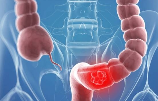 逆转奥沙利铂耐药性！中山大学发文：发现结直肠癌潜在治疗靶点