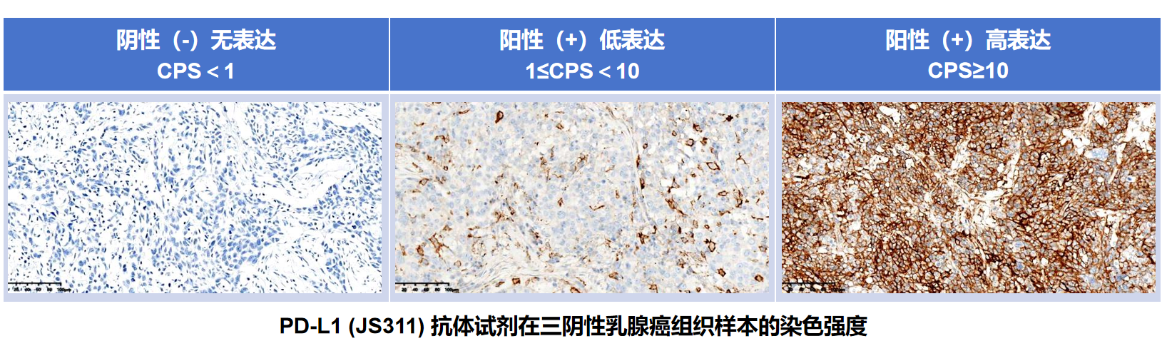 精准赋能·临床领先｜PD-L1（JS311）抗体试剂，引领三阴性乳腺癌伴随诊断技术革新