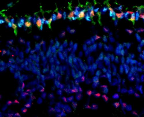 Nature：单一基因突变引发儿童患视网膜母细胞瘤的分子机制