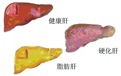 NIH：用于普通肝脏疾病的新药OCA能够改善肝脏的健康