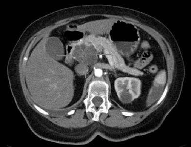 Cancer Discov：科学家鉴别出胰腺癌发生的关键第一步