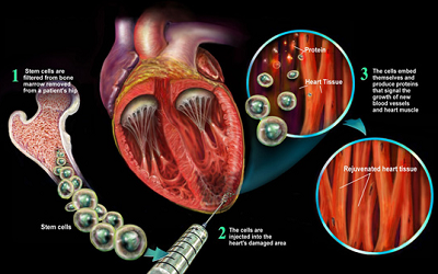新干细胞运输技术 增强心脏修复功能